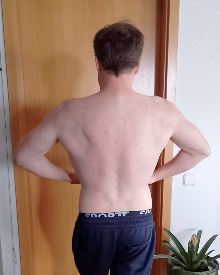 Vorher Bild Daniel - Rückenansicht